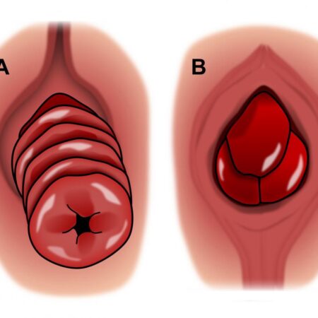 rectalprolapse_vs_hemorrhoid